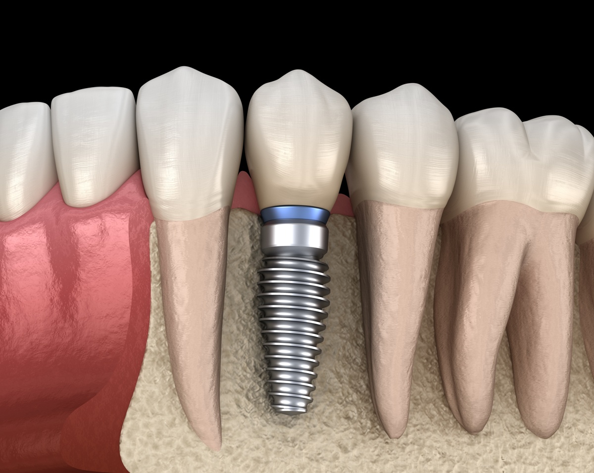 Implants dentaires Straumann 100% suisse de qualité supérieure