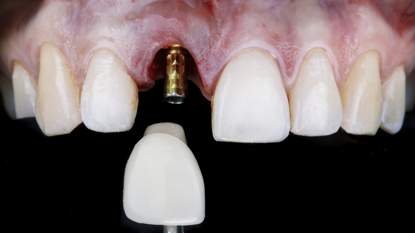 Implant dentaire à Meyrin