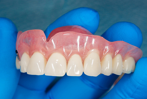Prothèse dentier adaptèe et esthètique