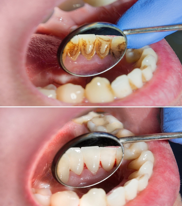 BUGUUYO 125 Feuilles Bavoir Dentaire Bavoirs Pour Les Soins Dentaires  Bavoirs D'Hygiène Des Patients Bavoirs De Clinique Dentaire Alimentation  Manger
